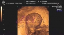 1543228343_12.trudnoća ekspertski 4D ultrazvuk od 20 24 nedelje trudnoće galerija