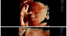 1543228346_15.trudnoća ekspertski 4D ultrazvuk od 20 24 nedelje trudnoće galerija