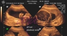 1543228768_05.trudnoća ekspertski 4D ultrazvuk od 25 27 nedelje trudnoće galerija