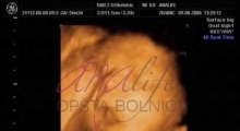 1543228770_11.trudnoća ekspertski 4D ultrazvuk od 25 27 nedelje trudnoće galerija