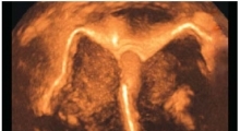 1544736417_ginekologija 3D ultrazvuk male karlice galerija 14