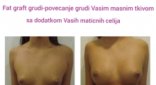 1552908028_plastična hirurgija povećanje grudi sa masnim ćelijama galerija 4