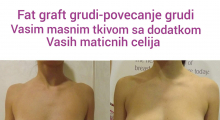 1552908029_plastična hirurgija povećanje grudi sa masnim ćelijama galerija 21