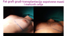 1552908030_plastična hirurgija povećanje grudi sa masnim ćelijama galerija 22