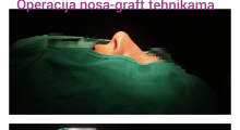 1552910200_plastična hirurgija operacija nosa galerija 11