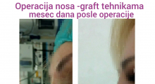 1552910202_plastična hirurgija operacija nosa galerija 14