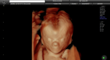 1553510759_trudnoća ekspertski 4D ultrazvuk od 11 13 nedelje trudnoće galerija 13