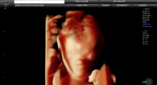 1553510759_trudnoća ekspertski 4D ultrazvuk od 11 13 nedelje trudnoće galerija 14