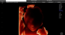 1553510760_trudnoća ekspertski 4D ultrazvuk od 11 13 nedelje trudnoće galerija 15