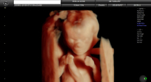 1553510760_trudnoća ekspertski 4D ultrazvuk od 11 13 nedelje trudnoće galerija 16