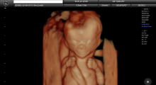 1553510761_trudnoća ekspertski 4D ultrazvuk od 11 13 nedelje trudnoće galerija 19