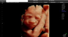 1553511079_20.trudnoca ekspertski 4D ultrazvuk od 20 24 nedelje trudnoce galerija