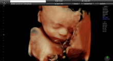 1553511080_21.trudnoca ekspertski 4D ultrazvuk od 20 24 nedelje trudnoce galerija