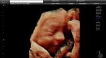 1553511080_22.trudnoca ekspertski 4D ultrazvuk od 20 24 nedelje trudnoce galerija