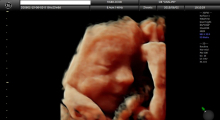 1553511080_23.trudnoca ekspertski 4D ultrazvuk od 20 24 nedelje trudnoce galerija