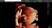 1553511474_15.trudnoca ekspertski 4D ultrazvuk od 25 27 nedelje trudnoce galerija