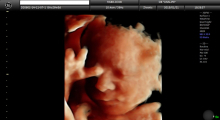 1553511474_16.trudnoca ekspertski 4D ultrazvuk od 25 27 nedelje trudnoce galerija