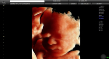 1553511475_17.trudnoca ekspertski 4D ultrazvuk od 25 27 nedelje trudnoce galerija