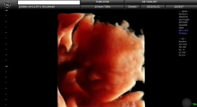 1553511475_18.trudnoca ekspertski 4D ultrazvuk od 25 27 nedelje trudnoce galerija