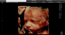 1553511475_19.trudnoca ekspertski 4D ultrazvuk od 25 27 nedelje trudnoce galerija