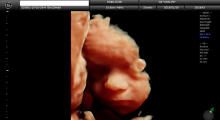 1553511477_21.trudnoca ekspertski 4D ultrazvuk od 25 27 nedelje trudnoce galerija