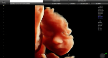 1553511478_22.trudnoca ekspertski 4D ultrazvuk od 25 27 nedelje trudnoce galerija