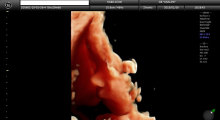 1553511479_23.trudnoca ekspertski 4D ultrazvuk od 25 27 nedelje trudnoce galerija