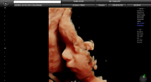 1553511480_24.trudnoca ekspertski 4D ultrazvuk od 25 27 nedelje trudnoce galerija