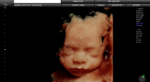 1553511481_25.trudnoca ekspertski 4D ultrazvuk od 25 27 nedelje trudnoce galerija