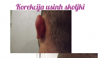 1553765409_plastična hirurgija operacije ušiju galerija 31