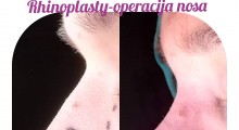 1553851374_plastična hirurgija operacija nosa galerija 39