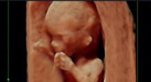 1554665568_trudnoća ekspertski 4D ultrazvuk od 11 13 nedelje trudnoće galerija 20