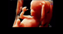 1554665569_trudnoća ekspertski 4D ultrazvuk od 11 13 nedelje trudnoće galerija 21
