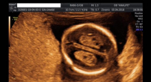 1554665884_trudnoca ekspertski 4D ultrazvuk od 14 19 nedelje trudnoce galerija 13