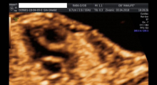 1554665884_trudnoca ekspertski 4D ultrazvuk od 14 19 nedelje trudnoce galerija 14