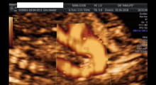 1554665885_trudnoca ekspertski 4D ultrazvuk od 14 19 nedelje trudnoce galerija 15