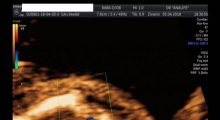 1554665885_trudnoca ekspertski 4D ultrazvuk od 14 19 nedelje trudnoce galerija 17