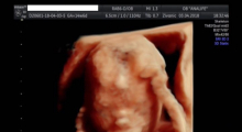 1554665886_trudnoca ekspertski 4D ultrazvuk od 14 19 nedelje trudnoce galerija 18