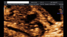 1554665889_trudnoca ekspertski 4D ultrazvuk od 14 19 nedelje trudnoce galerija 21