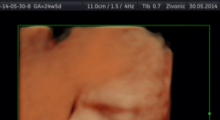 1554666223_28.trudnoca ekspertski 4D ultrazvuk od 20 24 nedelje trudnoce galerija