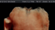 1554666224_31.trudnoca ekspertski 4D ultrazvuk od 20 24 nedelje trudnoce galerija