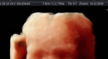 1554666224_32.trudnoca ekspertski 4D ultrazvuk od 20 24 nedelje trudnoce galerija