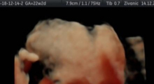 1554666225_34.trudnoca ekspertski 4D ultrazvuk od 20 24 nedelje trudnoce galerija