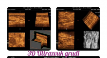 1581708733_01.2D 3D ultrazvuk dojke pazušnih jama podključnih i nadključnih regija galerija