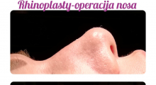 1583061579_plastična hirurgija operacija nosa galerija 46