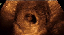 1587142773_trudnoća 4D 3D ultrazvučni pregled do 9 nedelje trudnoće galerija 13