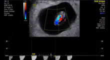 1587142773_trudnoća 4D 3D ultrazvučni pregled do 9 nedelje trudnoće galerija 14