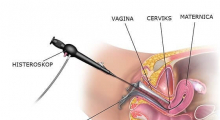 1599765225_11.Hysteroscopy gallery