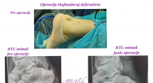 1622833201_04.ortopedija artroskopija hanglundova peta